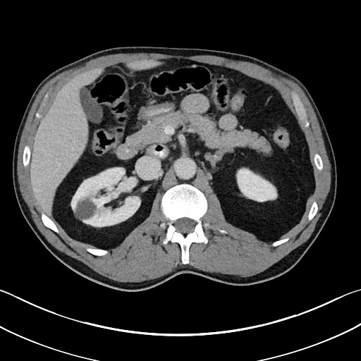 Closed loop small bowel obstruction - internal hernia (Radiopaedia 57806-64778 B 42).jpg