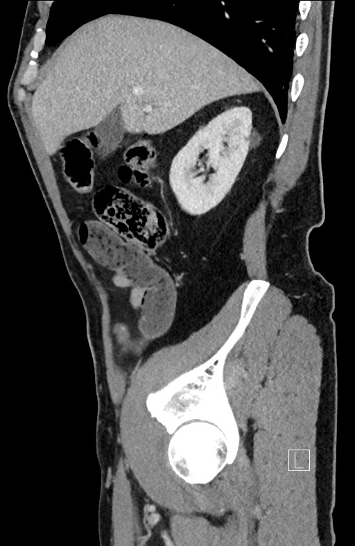Closed loop small bowel obstruction - internal hernia (Radiopaedia 57806-64778 C 84).jpg