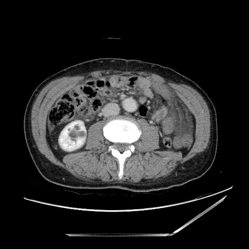 File:Closed loop small bowel obstruction - omental adhesion causing "internal hernia" (Radiopaedia 85129-100682 A 86).jpg