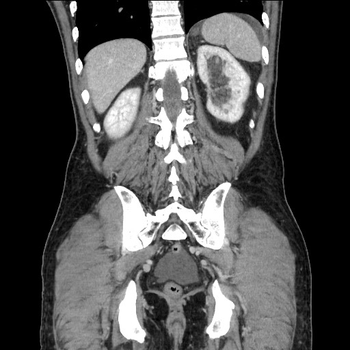 Closed loop small bowel obstruction - omental adhesion causing "internal hernia" (Radiopaedia 85129-100682 B 98).jpg
