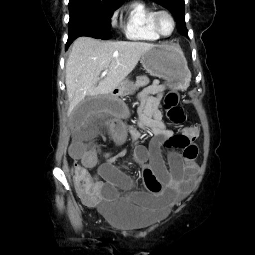 Closed loop small bowel obstruction due to adhesive band, with intramural hemorrhage and ischemia (Radiopaedia 83831-99017 C 40).jpg