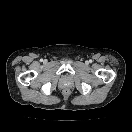 File:Closed loop small bowel obstruction due to adhesive band - U-shaped loop (Radiopaedia 83829-99012 A 73).jpg