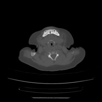 Cloverleaf skull (Radiopaedia 91901-109710 Axial bone window 20).jpg