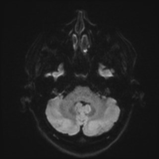 Cochlear incomplete partition type III associated with hypothalamic hamartoma (Radiopaedia 88756-105498 Axial DWI 49).jpg