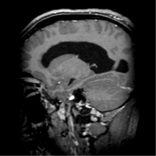 File:Colloid cyst (Radiopaedia 53164-59125 F 29).png