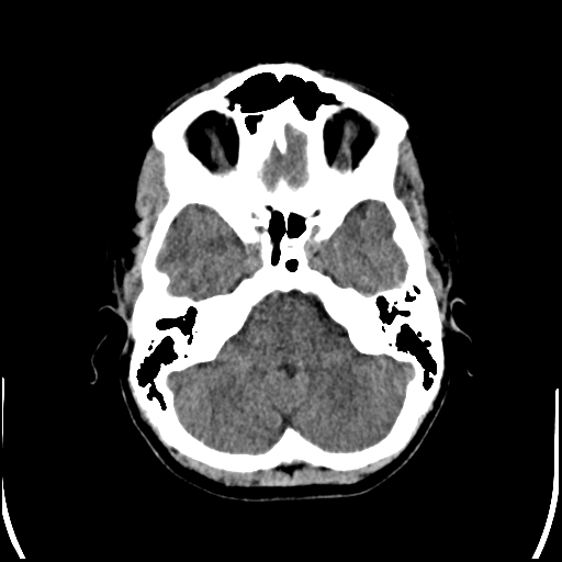 Colloid cyst (Radiopaedia 78104-90633 Axial non-contrast 25).jpg