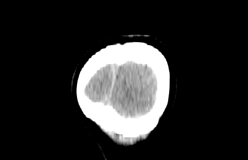 Colloid cyst (Radiopaedia 88663-105373 Coronal non-contrast 67).jpg