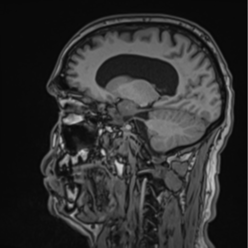 File:Colloid cyst of the third ventricle (Radiopaedia 86571-102662 Sagittal T1 31).png