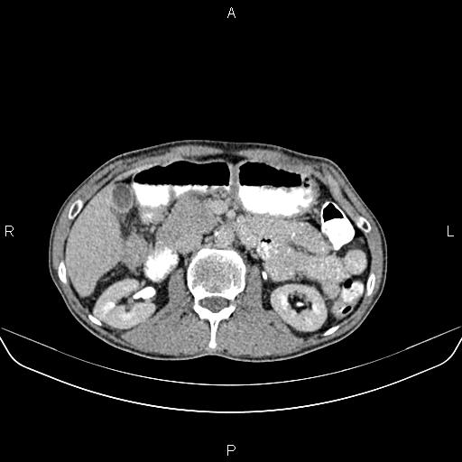 File:Colon adenocarcinoma - hepatic flexure (Radiopaedia 85635-101395 Axial C+ delayed 35).jpg