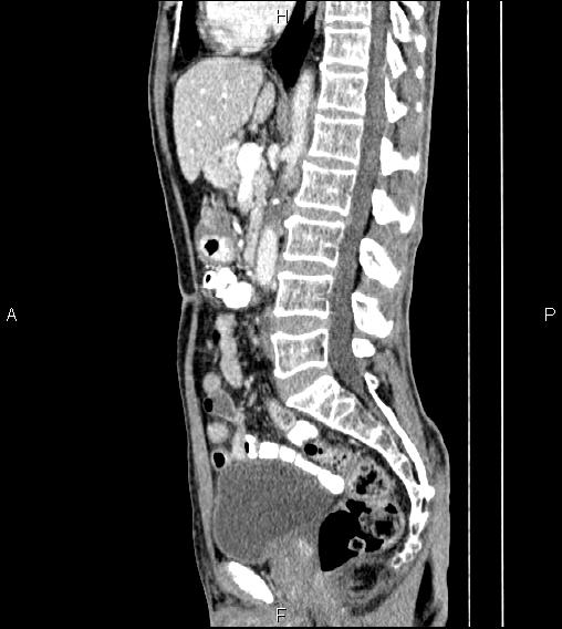 Colon adenocarcinoma - hepatic flexure (Radiopaedia 85635-101395 D 45).jpg