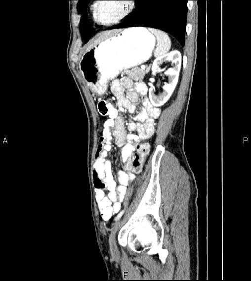 Colon adenocarcinoma - hepatic flexure (Radiopaedia 85635-101395 D 67).jpg