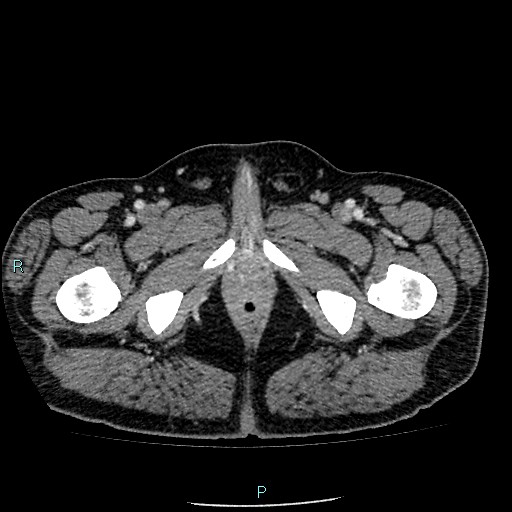 Colon adenocarcinoma with calcific liver metastasis (Radiopaedia 55745-62300 B 50).jpg