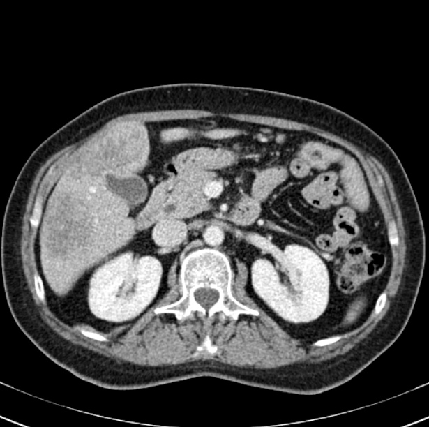 Colon carcinoma with hepatic metastases (Radiopaedia 29477-29961 A 42).jpg