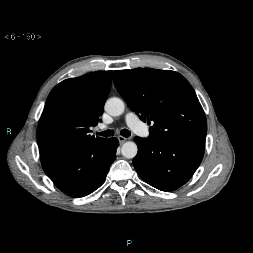 Colonic cancer (ultrasound and TC imaging) (Radiopaedia 50346-55713 B 150).jpg