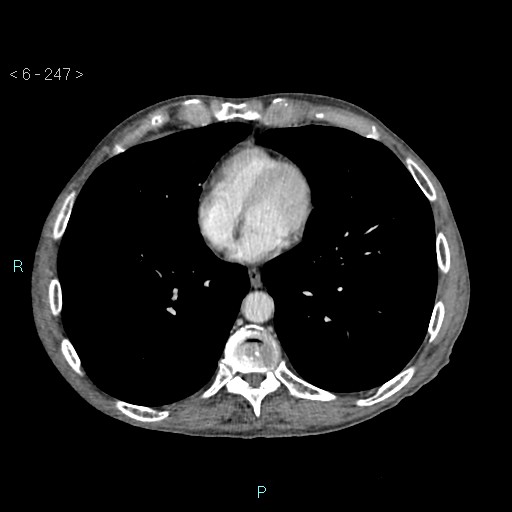 File:Colonic cancer (ultrasound and TC imaging) (Radiopaedia 50346-55713 B 247).jpg