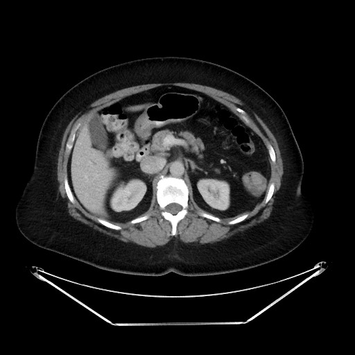 File:Colonic intussusception due to adenocarcinoma (Radiopaedia 86828-102987 A 52).jpg