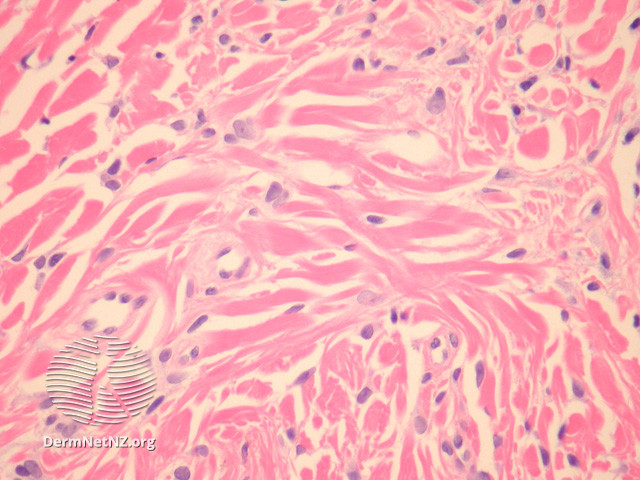 File:Figure 2 (DermNet NZ pathology-e-angiofibroma-figure-2).jpg