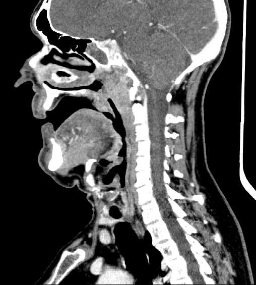 File:Nasopharyngeal carcinoma - infiltrating the clivus (Radiopaedia 62583-70875 C 24).jpg