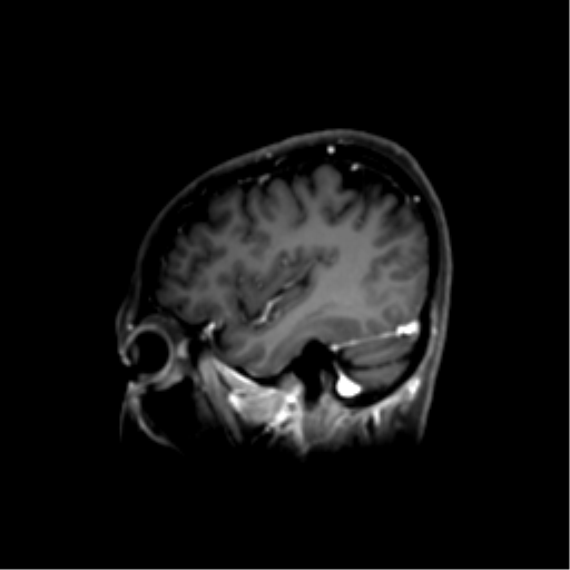File:Nasopharyngeal carcinoma with cerebral abscess (Radiopaedia 43018-46274 J 42).png