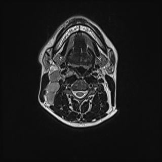 File:Nasopharyngeal carcinoma with perineural spread (Radiopaedia 55030-61380 Axial T2 48).jpg