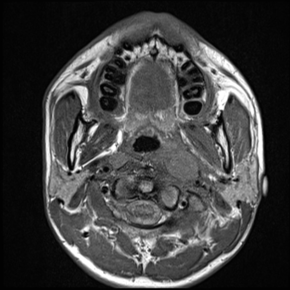File:Nasopharyngeal carcinoma with skull base invasion (Radiopaedia 53415-59485 Axial T1 35).jpg