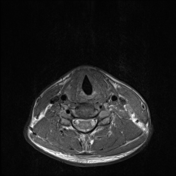 Nasopharyngeal carcinoma with skull base invasion (Radiopaedia 53415-59485 Axial T1 59).jpg