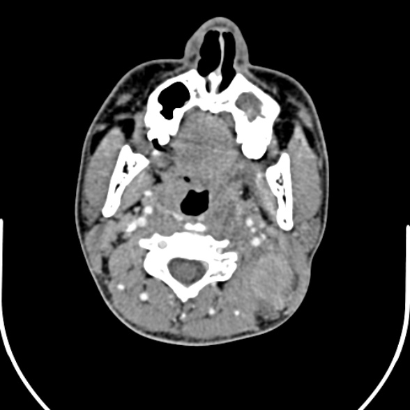 Nasopharyngeal carcinoma with skull base invasion (Radiopaedia 53415-59705 A 84).jpg
