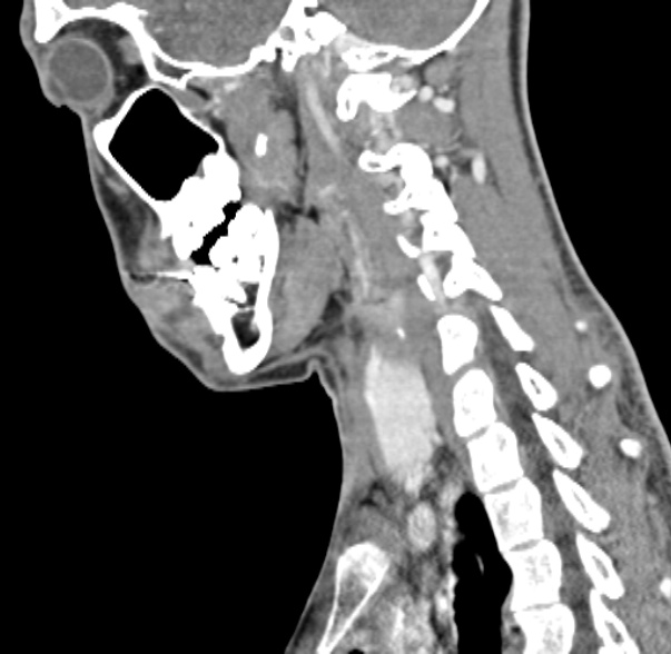 Nasopharyngeal carcinoma with skull base invasion (Radiopaedia 53415-59705 C 24).jpg