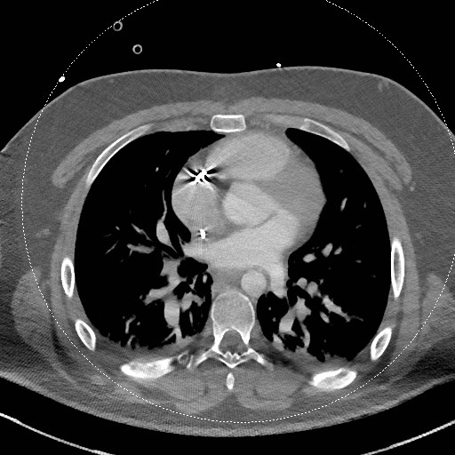 File:Neck CT angiogram (intraosseous vascular access) (Radiopaedia 55481-61945 B 2).jpg