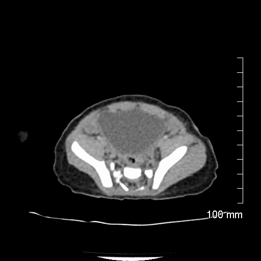 File:Neonatal neuroblastoma (Radiopaedia 56651-63438 Axial non-contrast 66).jpg