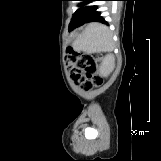File:Neonatal neuroblastoma (Radiopaedia 56651-63438 C 20).jpg