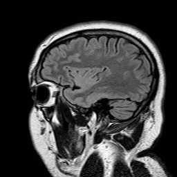 File:Neuro-Behcet's disease (Radiopaedia 21557-21506 Sagittal FLAIR 7).jpg