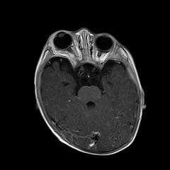 File:Neurofibromatosis type 1 (Radiopaedia 30089-30671 Axial T1 C+ 8).jpg