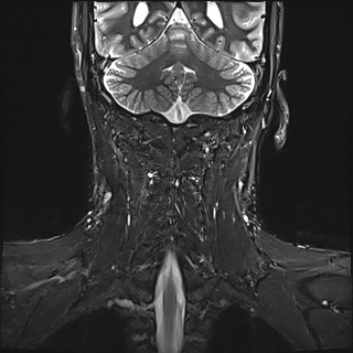File:Neurofibromatosis type 1 (Radiopaedia 80355-93740 Coronal STIR 11).jpg