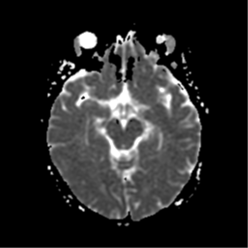 File:Neurofibromatosis type 2 - bilateral acoustic neuromata (Radiopaedia 40060-42566 Axial ADC 9).png