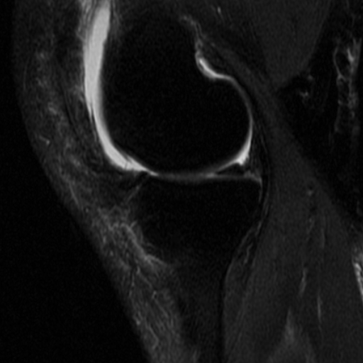 File:Non-displaced patella fracture (Radiopaedia 15932-15582 Sagittal T2 fat sat 6).jpg
