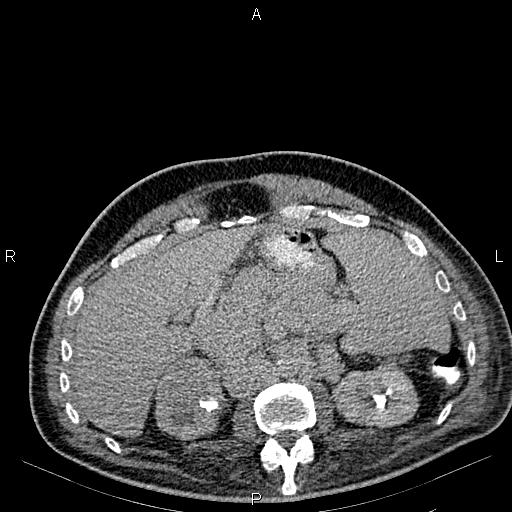 Non Hodgkin lymphoma in a patient with ankylosing spondylitis (Radiopaedia 84323-99621 Axial C+ delayed 24).jpg