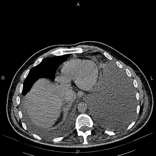 File:Non Hodgkin lymphoma in a patient with ankylosing spondylitis (Radiopaedia 84323-99621 Axial non-contrast 23).jpg