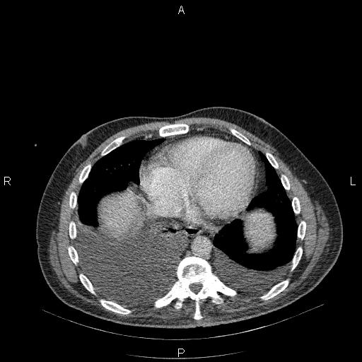 File:Non Hodgkin lymphoma in a patient with ankylosing spondylitis (Radiopaedia 84323-99624 B 21).jpg