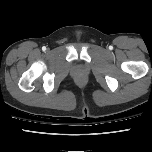 File:Normal CT angiogram of pelvis (Radiopaedia 45390-49430 A 53).jpg