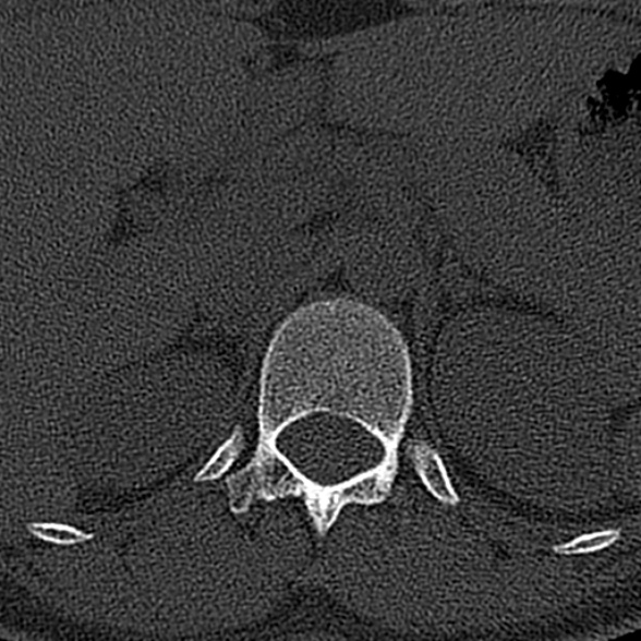 File:Normal CT lumbar spine (Radiopaedia 53981-60118 Axial bone window 3).jpg