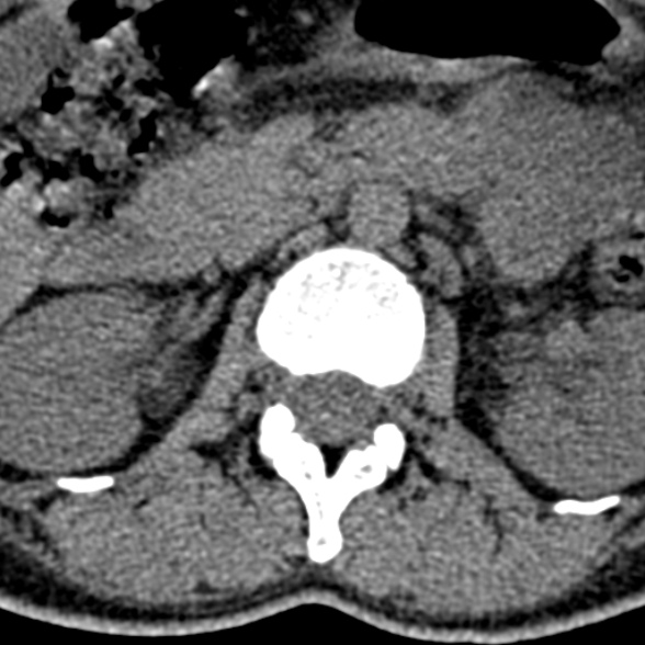 Normal CT lumbar spine (Radiopaedia 53981-60118 Axial non-contrast 26).jpg