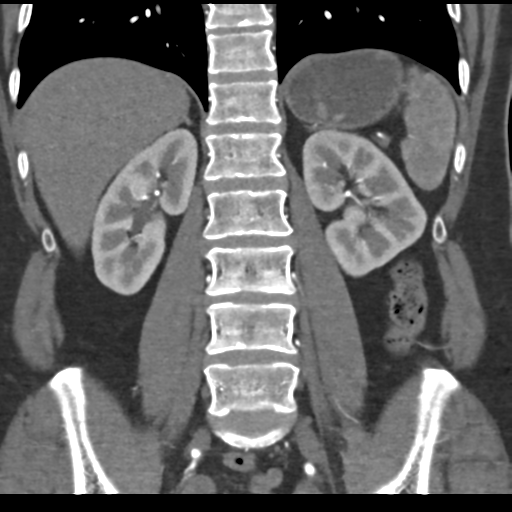 File:Normal CT renal artery angiogram (Radiopaedia 38727-40889 B 51).png