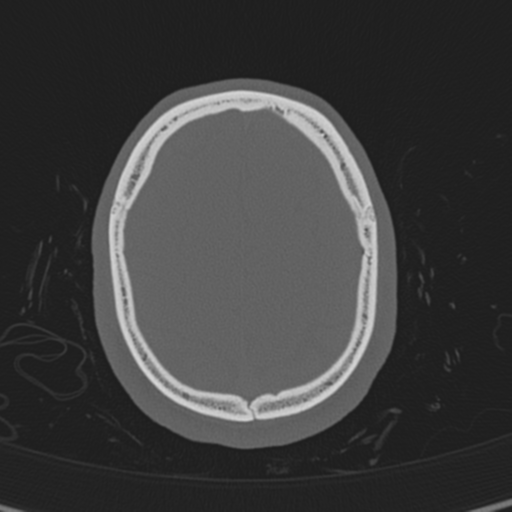 Normal CT skull (Radiopaedia 40798-43459 A 131).png