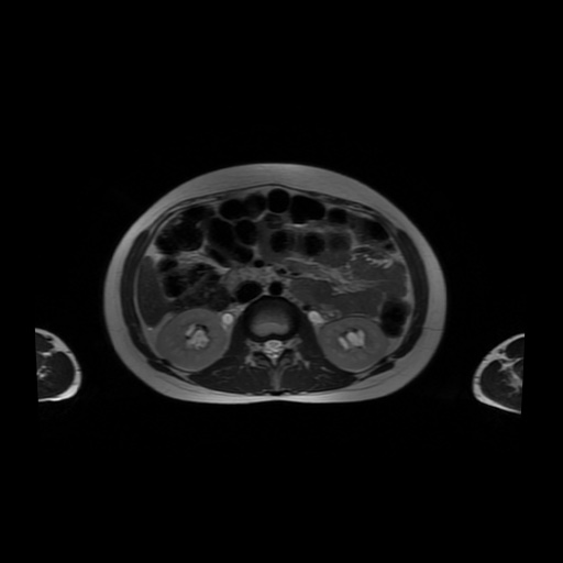 File:Normal MRI abdomen in pregnancy (Radiopaedia 88001-104541 Axial T2 27).jpg