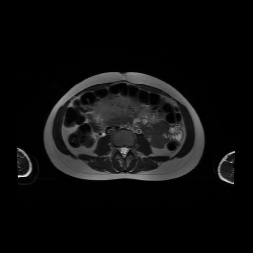 File:Normal MRI abdomen in pregnancy (Radiopaedia 88001-104541 Axial T2 35).jpg