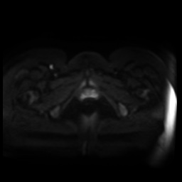 Normal MRI abdomen in pregnancy (Radiopaedia 88005-104548 Axial DWI 78).jpg