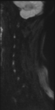 File:Normal MRI cervical spine (infection protocol) (Radiopaedia 53916-60039 Sagittal DWI 26).png