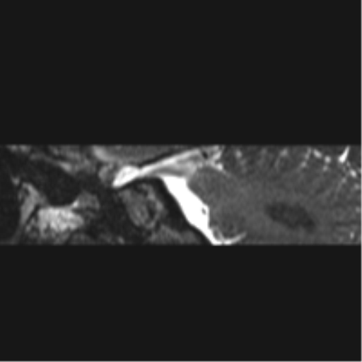 Normal MRI internal auditory canal (Radiopaedia 41613-44525 C 77).png