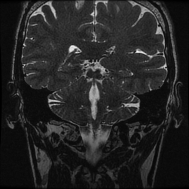 Normal MRI petrous (Radiopaedia 91317-108949 Coronal T2 78).jpg